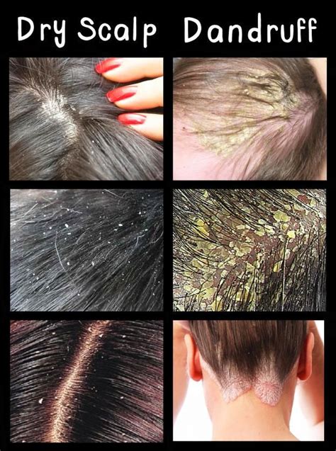 Pin by L&G Hair Studio on Fun, Facts & Myths pertaining to Beauty | Hair dandruff, Dandruff ...