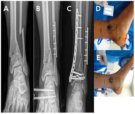 Distal Tibia Fracture