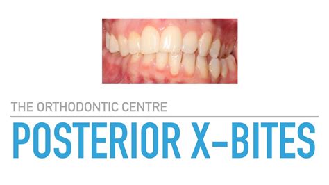 Posterior Cross-Bite Correction at The Orthodontic Centre - YouTube