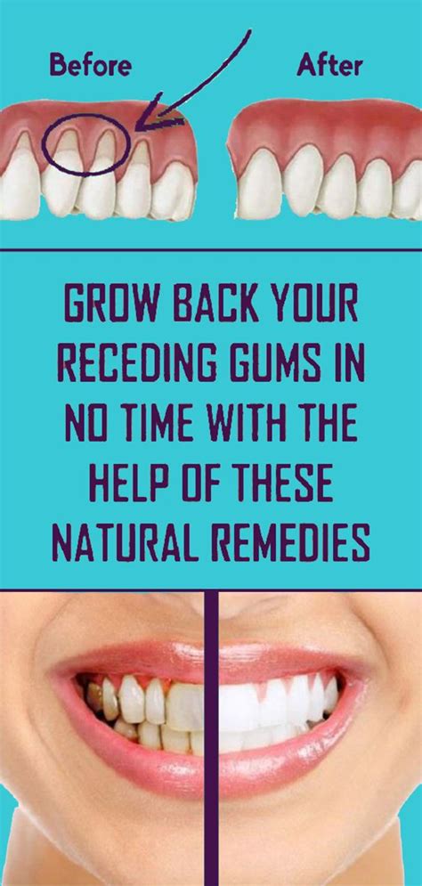 Treat Receding Gums Naturally Using These Methods - Home Remedies