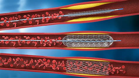 EP 218 – FEMORAL ARTERY STENT - Ruth Werner