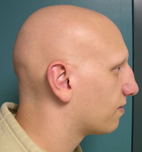 Alopecia Totalis - Symptoms, Causes and Treatment