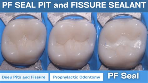 PF SEAL || Light Cure Pit and Fissure Sealant || Procedure in Maxillary Molar - YouTube