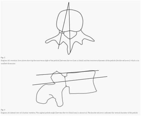 Pedicle Screw Insertion Simplified | Epomedicine