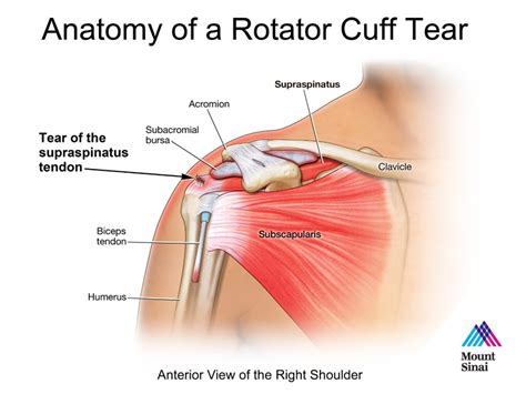 Rotator cuff problems - Sports Medicine