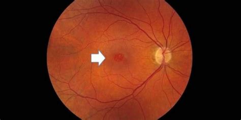 Understand the symptoms, causes, treatment of a Macular Hole