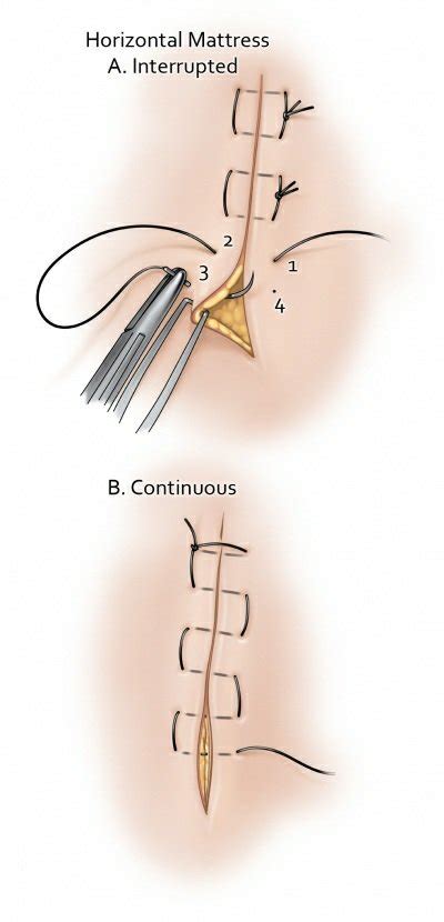 corpulento Automazione Alice running vertical mattress suture Combattente mestruazione Atlante