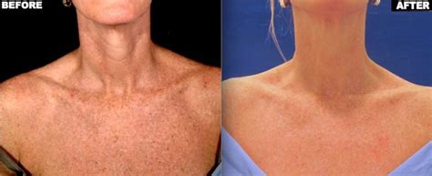 Age Spots - Union Square Laser Dermatology