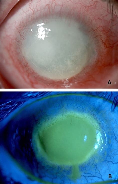 Acanthamoeba Facts, Eye Infection, and Keratitis | Owlcation