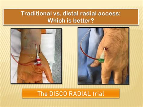 Distal radial access not better than conventional approach in preventing radial artery occlusion ...