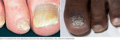 Nail fungus - Symptoms and causes (2023)