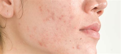 Here’s the Problem with Acne Scar Removal Home Remedies