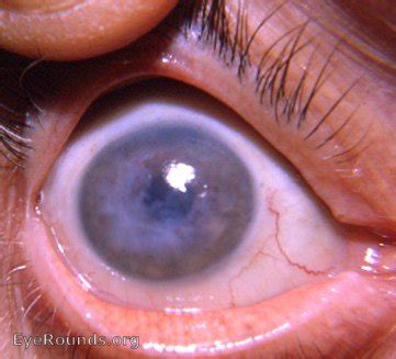 Fuch's Endothelial Corneal Dystrophy. EyeRounds.org: Online Ophthalmic ...