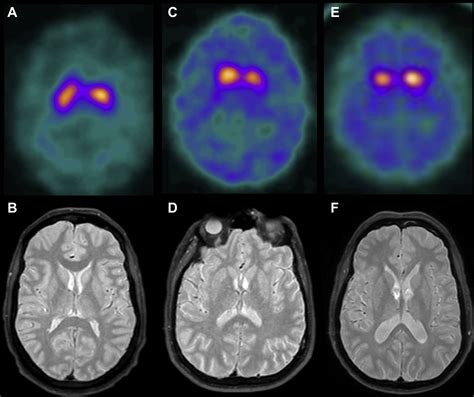 Dopamine Transporter SPECT Imaging in Parkinson Disease and Dementia - PET Clinics