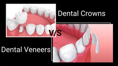 What is the Difference Between Dental Crowns and Dental Veneers?