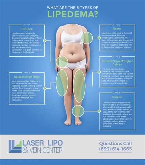 Image result for lipoedema compression | Lipedema treatment, Lipedema ...