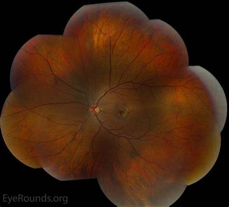 Early onset macular drusen and C3 glomerulopathy (formerly type II ...