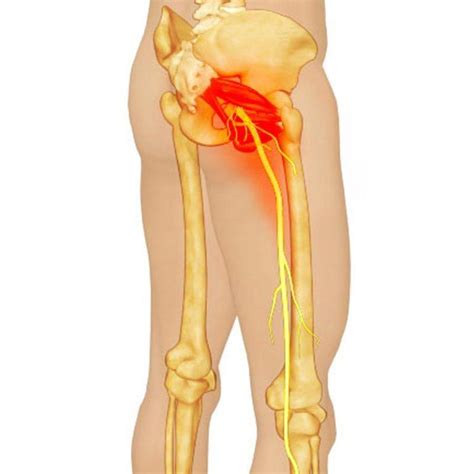 Piriformis Syndrome Pain