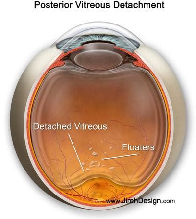 Vitreous detachment (PVD) guide with illustrations & photos