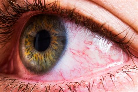 Why Are My Eyes Red? 12 Causes and How to Treat Them