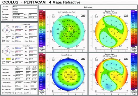 Left eye corneal topography of patient number 2 | Download Scientific Diagram