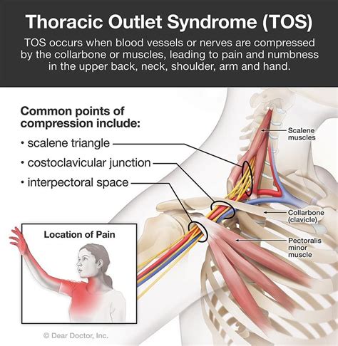 Thoracic Outlet Syndrome | Chiropractor In Tampa, FL | Dr. George Kollias