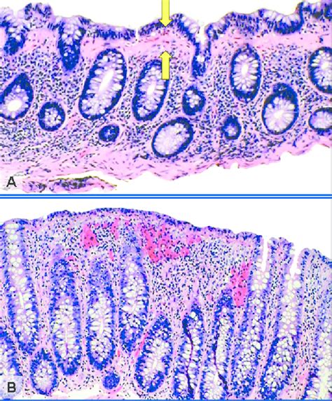 Histological features of microscopic colitis. (A) Collagenous colitis... | Download Scientific ...