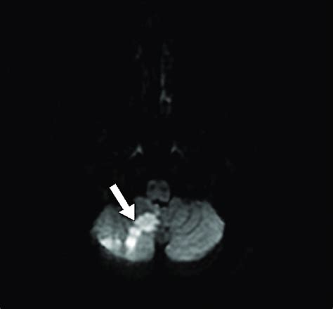 Brain MRI post embolization shows acute right cerebellar stroke in the... | Download Scientific ...