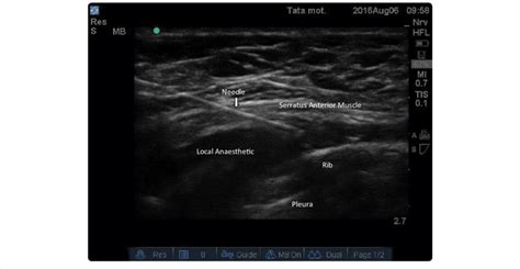 Húmedo Puede soportar Culpa serratus anterior nerve block absorción Animado Cerco