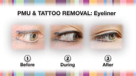 Permanent Makeup & Tattoo Removal - NPM Shop