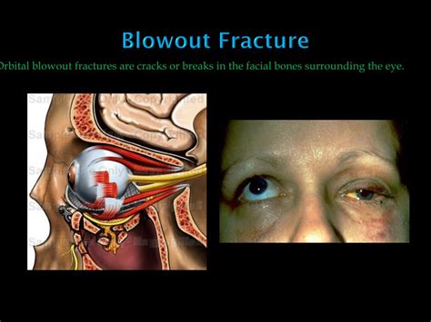 PPT - Fracture Types PowerPoint Presentation, free download - ID:2339788