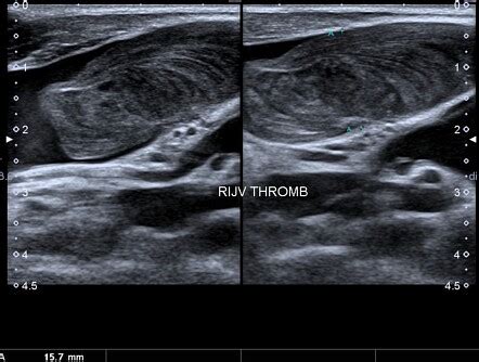 Internal jugular venous thrombosis | Radiology Case | Radiopaedia.org