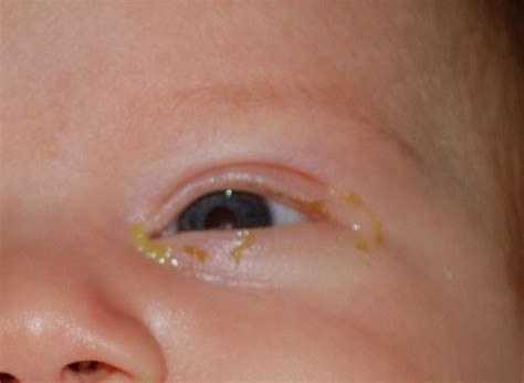 Blocked Tear Duct: Symptoms, Causes And Treatment