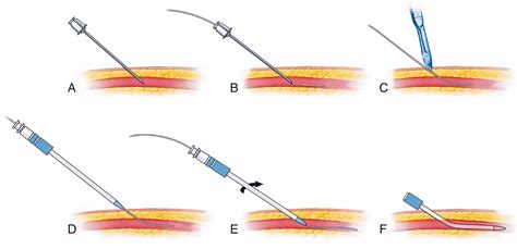 Coronary Angiography and Intravascular Imaging - Clinical Tree