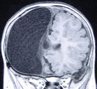 Hemispherectomy | Cleveland Clinic