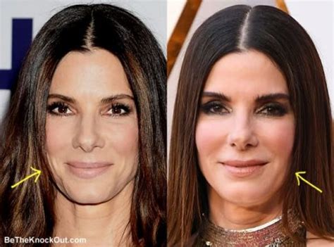 Sandra Bullock Plastic Surgery Comparison Photos