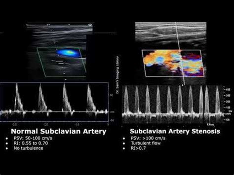 Subclavian Artery Doppler Ultrasound Normal Vs Abnormal Images | Stenosis & Steal Syndrome USG ...