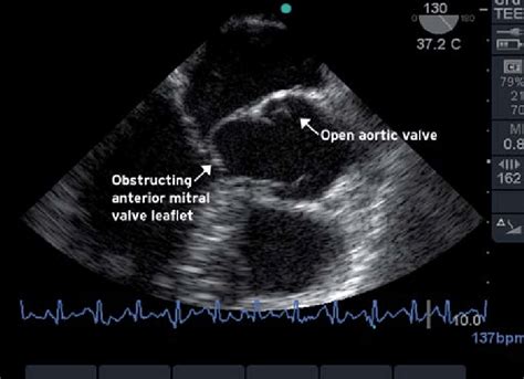 Mitral Valve Leaflet Anatomy