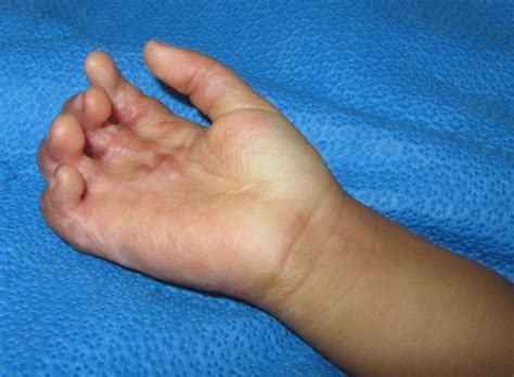 Surgical treatment of paediatric postburn contracture of the hand