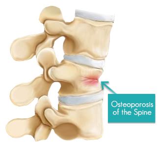 Osteoporosis of the Spine | Causes & Treatment | Total Ortho Center