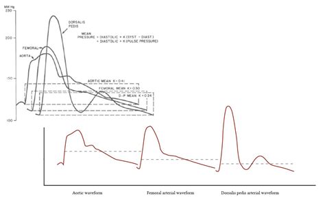 Normal arterial line waveforms | Deranged Physiology