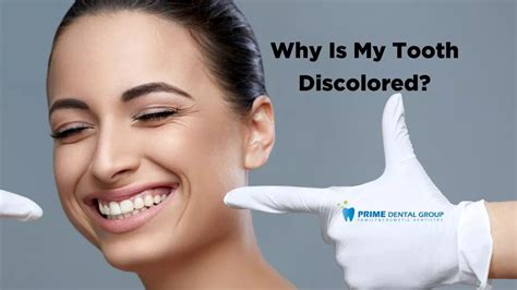 10 Causes of Tooth Discoloration (2024) | Prime Dental Group