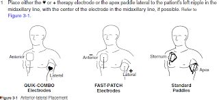 biomedical engineer: Defibrillator