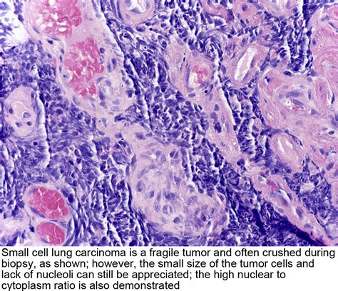 Pathology Outlines - Small cell carcinoma