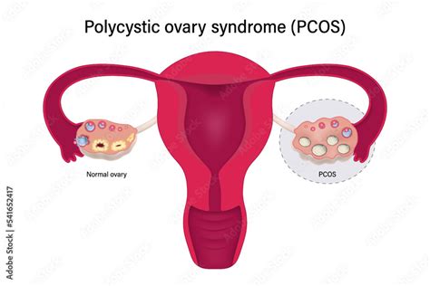 Polycystic ovary syndrome PCOS. Multiple immature follicles vector. Ovarian cysts with female ...