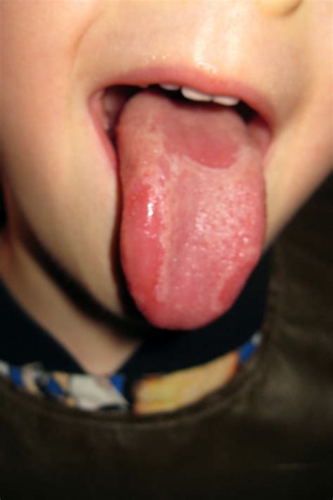 Geographic Tongue in Toddlers and Children - Geographic Tongue ...