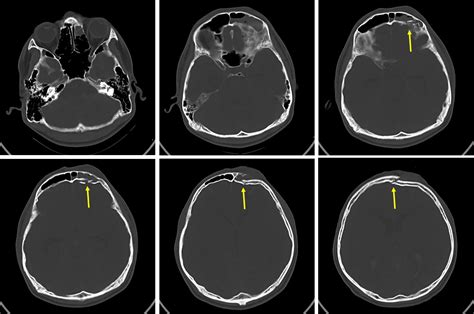 Frontal bone fracture and frontal sinus injury – Radiology Cases