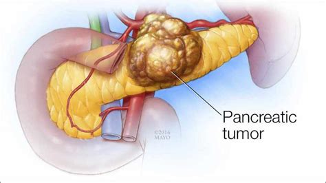 Mayo Clinic Radio: Pancreatic cancer - Mayo Clinic News Network