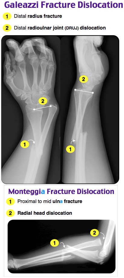 Monteggia fracture, Galeazzi fracture - Ortho - MSK - ER | Emergency medicine, Medical knowledge ...