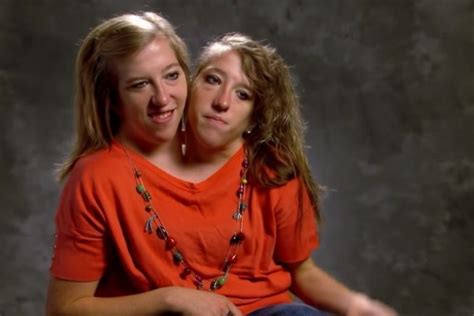 Years After These Siamese Twins Were Born, They Have Something To Share